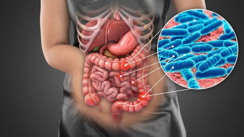 Disbiose Intestinal